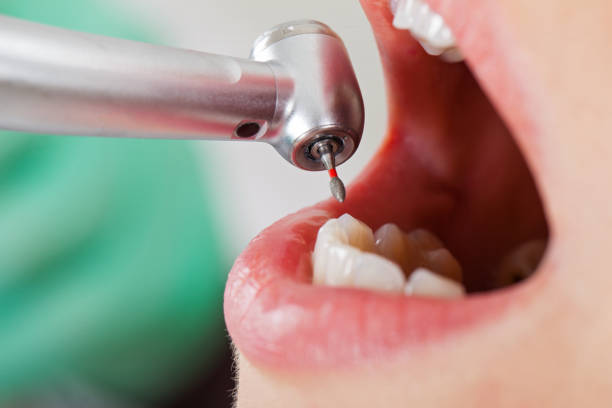 Best Chipped Tooth Repair Near Me  in Home Garden, CA